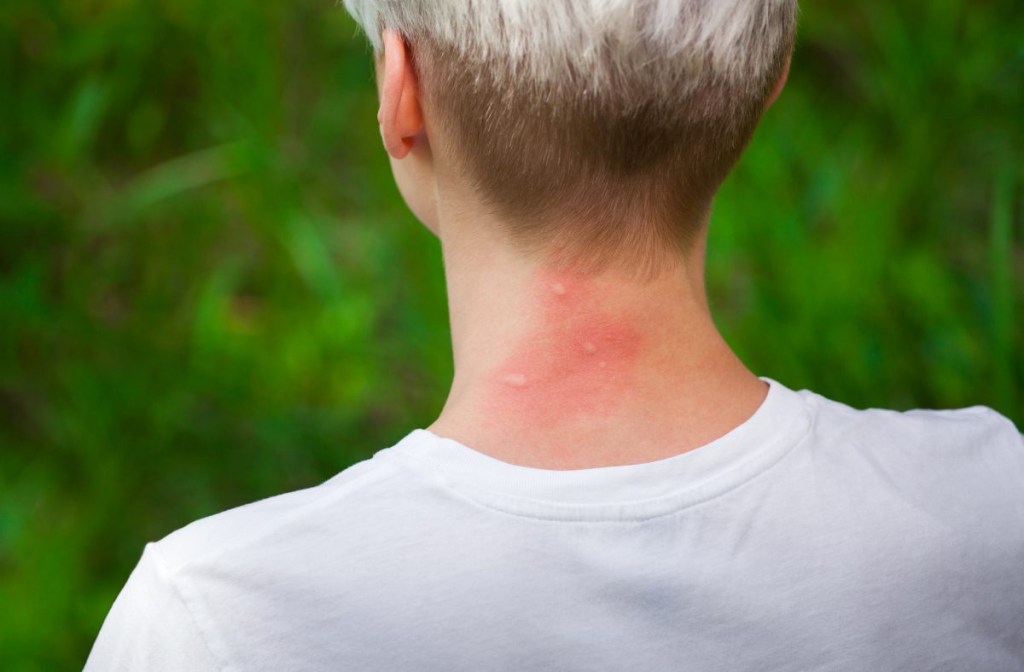 Pessoa de costas com picadas de inseto vermelhas no pescoço.